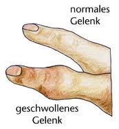 geschwollenes Gelenk geschwollenes Gelenk.jpg